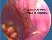 Удаление инородного тела из гортани