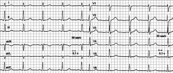 Электрокардиограмма (медосмотр)