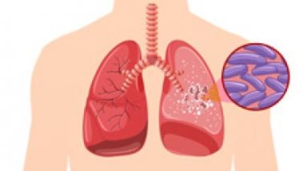 Возбудитель туберкулеза, качественное определение ДНК Mycobacterium tuberculosis