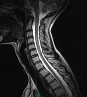 Магнитно-резонансная томография шейного отдела позвоночника
