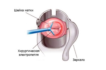 Коагуляция шейки матки